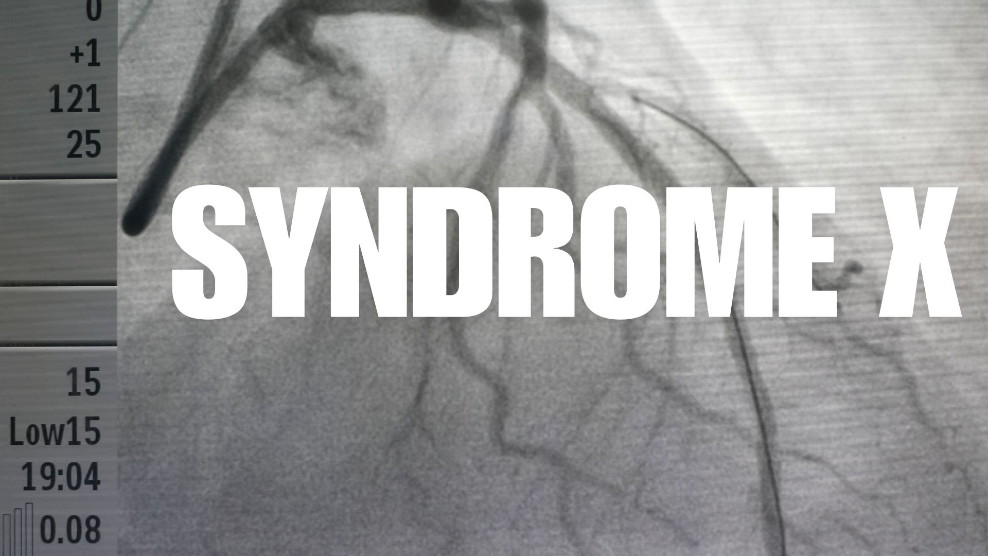 Syndrome X